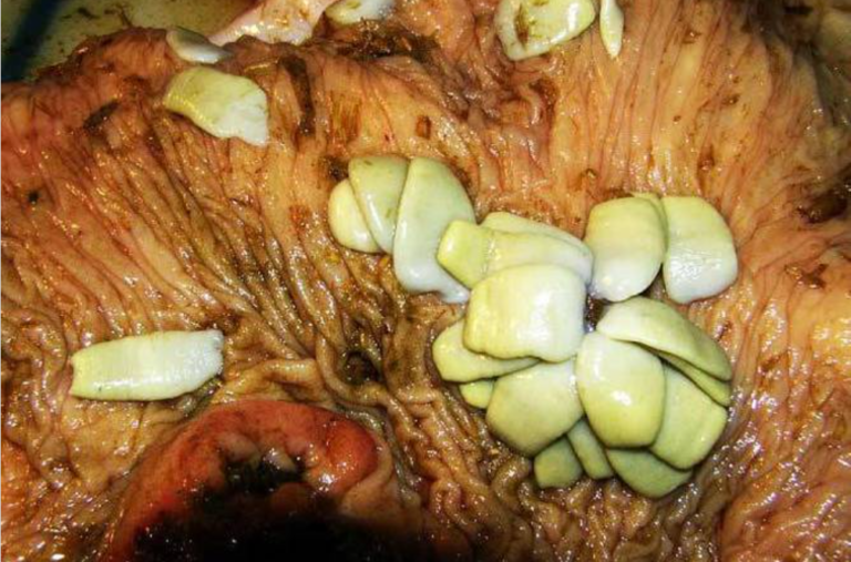 tapeworm